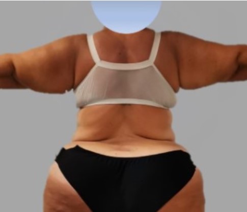 Lipedema